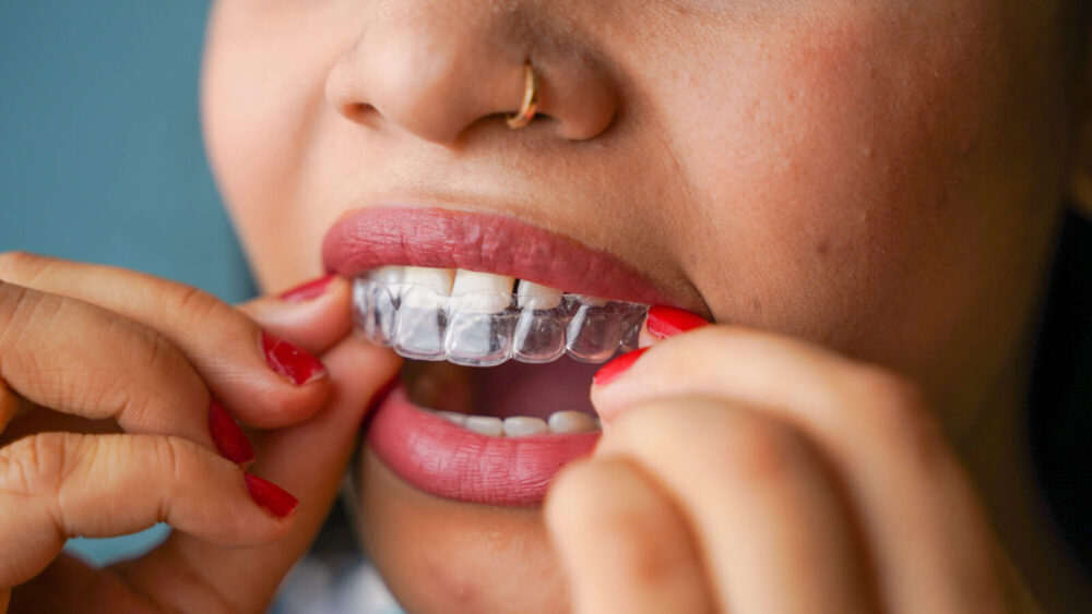 Braces & aligners