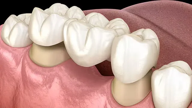 Dental Crowns & Bridges | Krity 360 | Bangalore