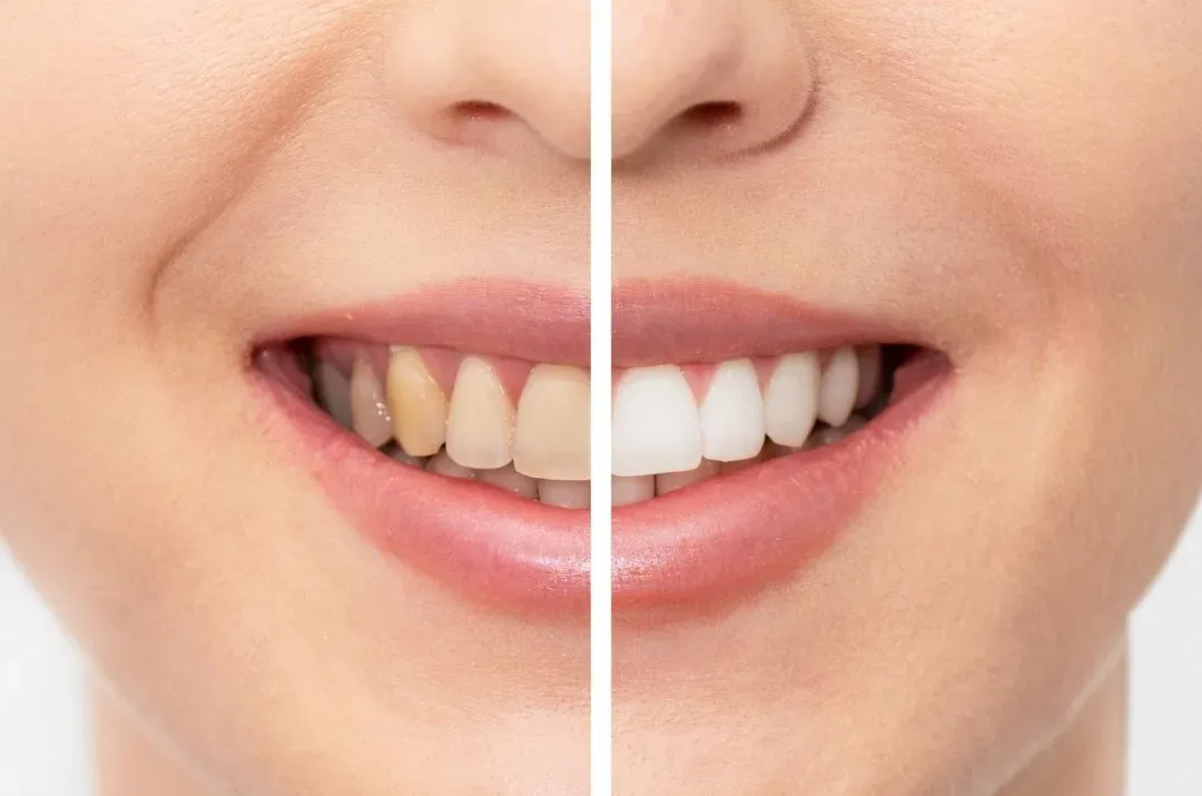Professional Teeth Whitening | Krity 360 | Bangalore