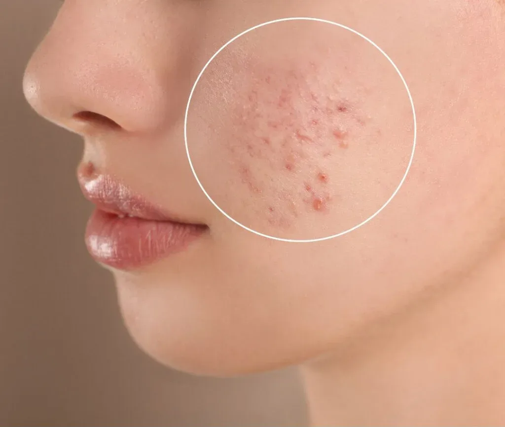 Acne Scars & Skin Texture