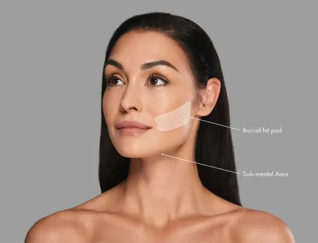 Buccal Fat Removal | Krity 360 | Bangalore