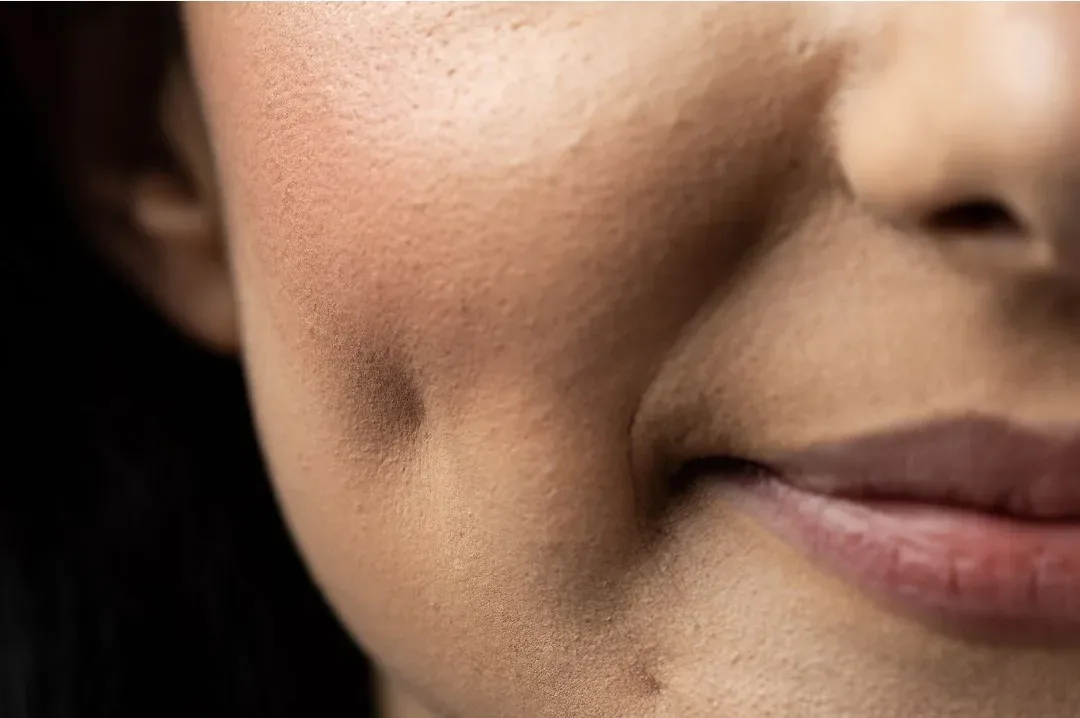 Dimpleplasty | Krity 360 | Bangalore