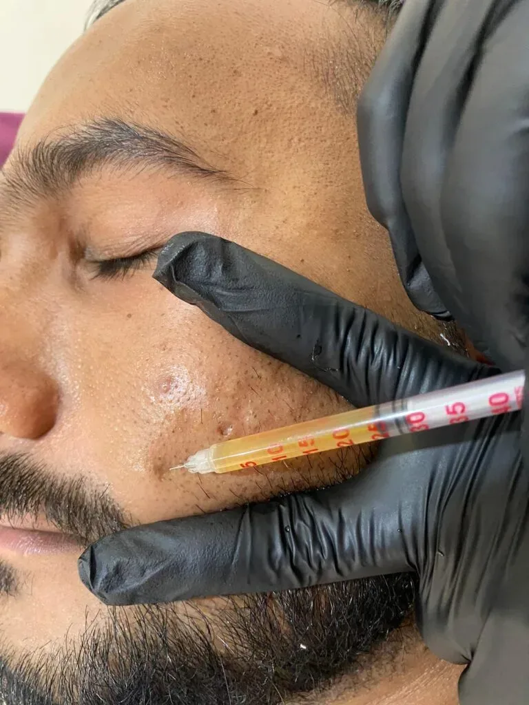 PRP & GFC Skin Treatment | Krity 360 | Bangalore