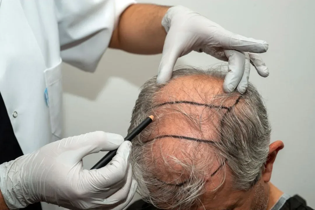 Hair Transplant Surgery | Krity 360 | Bangalore