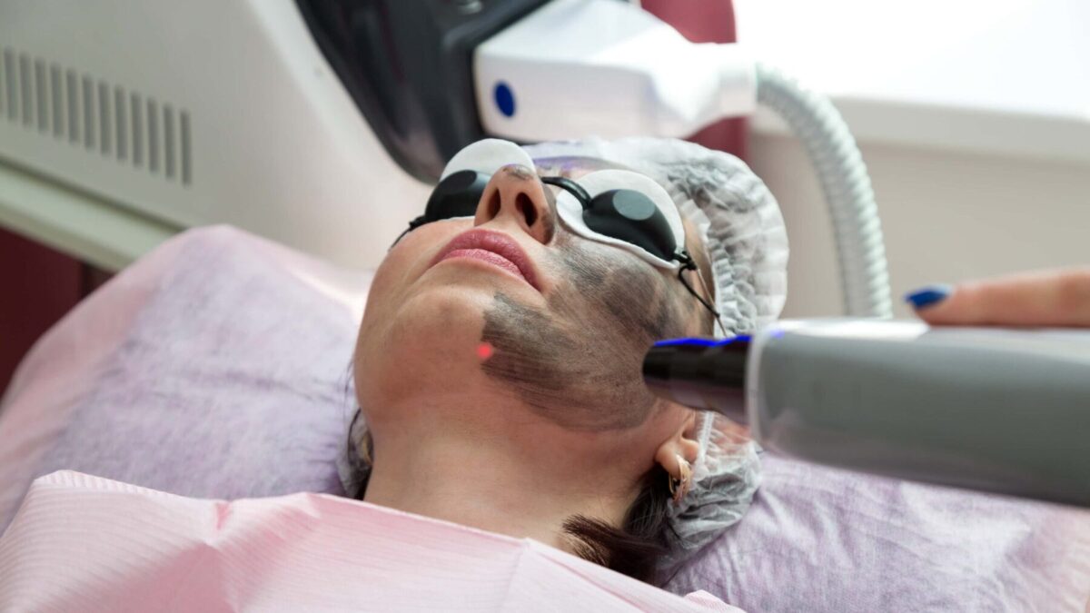 Carbon Laser Treatment in Bangalore