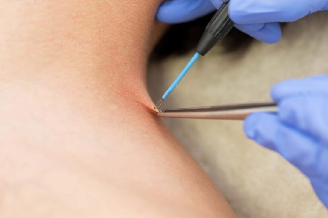 Mole and wart removal