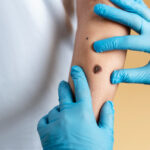 Clear Skin Solutions: Understanding Skin Tag and Wart Removal in Bangalore