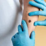 Skin Tag and Wart Removal | Krity 360 | Bangalore