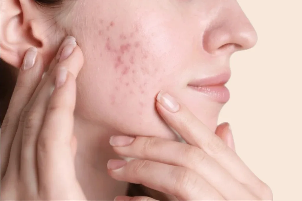 Acne Scar Treatment | Krity 360 | Bangalore