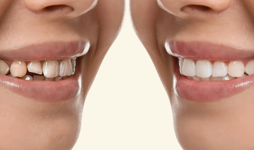 Dental Bonding | Krity 360 | Bangalore