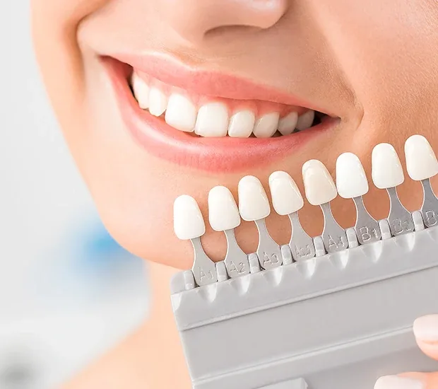 Dental Veneers | Krity 360 | Bangalore